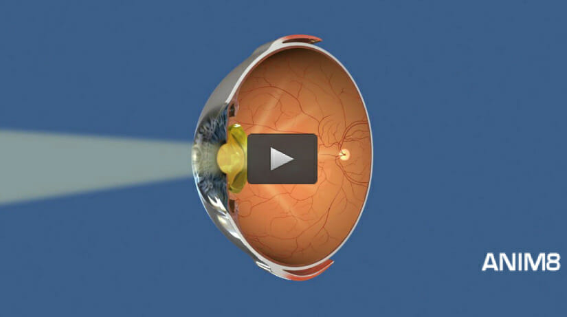 ophthalmology animations for websites
